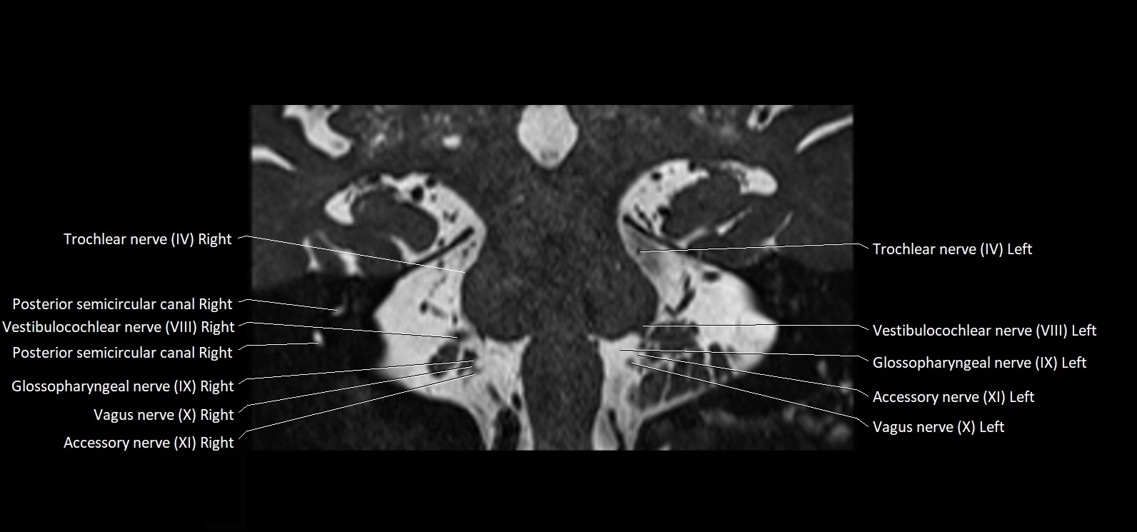 Cranial nerve cross sectional anatomy coronal 3T MRI image 46.webp